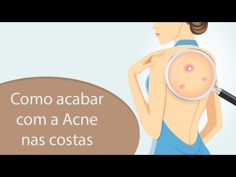how-to-stop-pimples-on-the-back---quick-and-natural-way