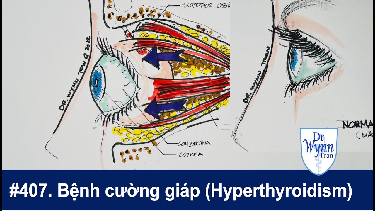 #407. Bệnh cường giáp (dư thừa hormone tuyến giáp) Hyperthyroidism