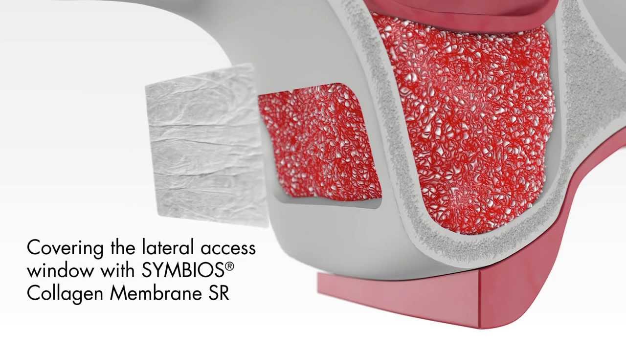 SYMBIOS Sinus Lift Animation - YouTube
