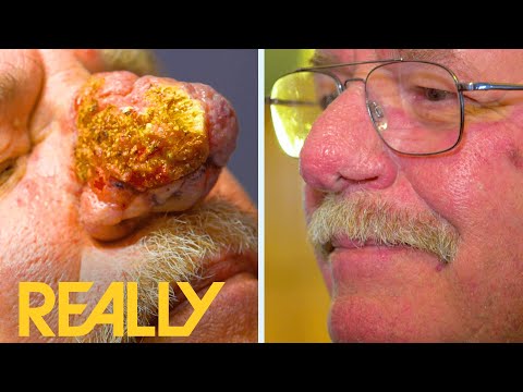 Dr. Lee Treats The Most Severe Case Of Rhinophyma She’s Seen I Dr. Pimple Popper