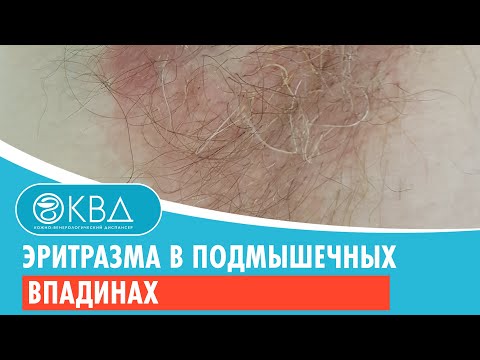 Эритразма в подмышечных впадинах. Клинический случай №137