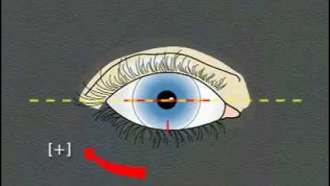 fitting soft toric lens.mp4