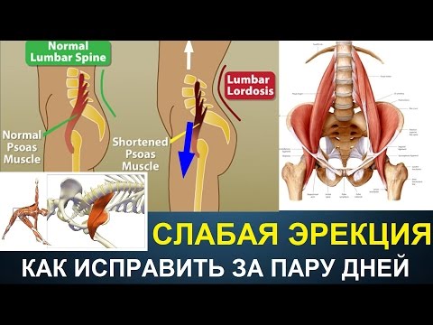 Эректильная дисфункция. Боль в спине. Сгибатели бедра. Back Pain And Erectile Dysfunction