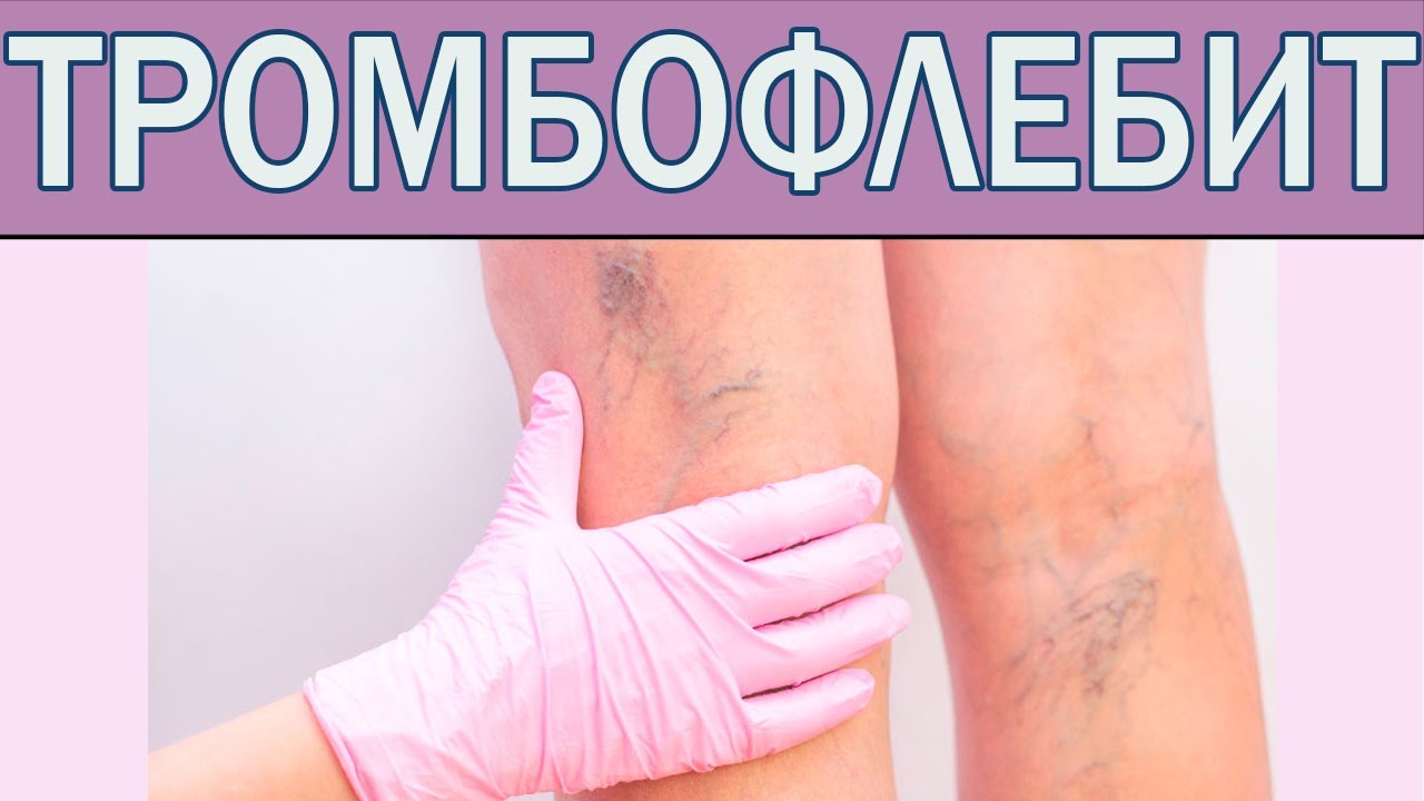 Какие препараты принимают при тромбофлебите? Лечение тромбофлебита ...