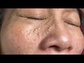 Make your acne treatment huong da nang502  acne 2022 part 1