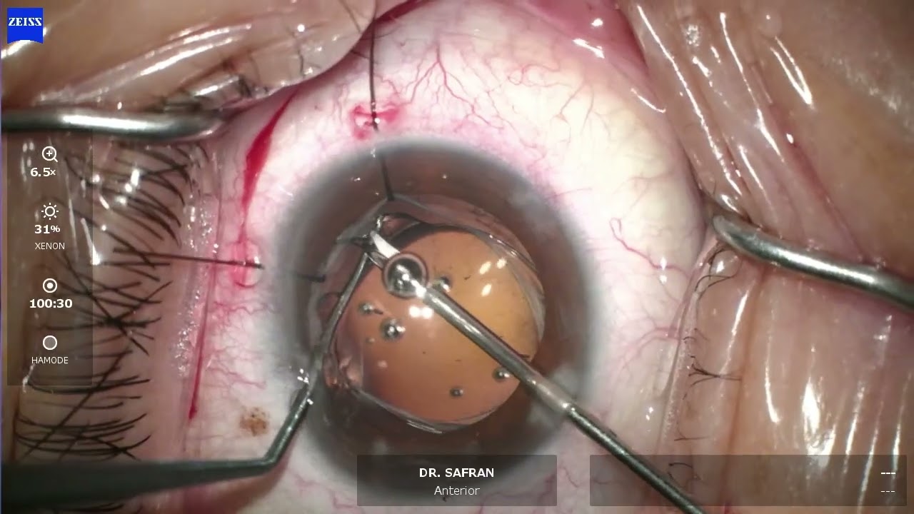 Rayner Galaxy exchange by Steven G. Safran MD