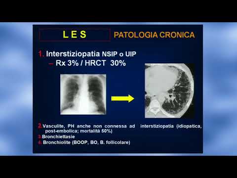 Video: Malattia Vascolare Del Collagene: Cause, Sintomi E Trattamenti