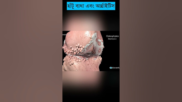 হাঁটু ব্যথা এবং বাত | আর্থ্রাইটিস, চিকিৎসা এবং নিরাময় বোঝা