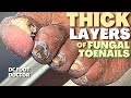 Thick Layers of Fungal Toenails