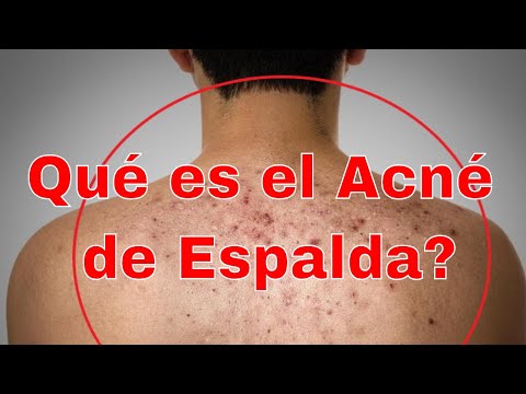 ✔🔴Qué es el Acné de Espalda?