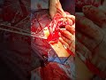 Redo accreta  uterine preservation   after failed 1st trial by another technique with voice over