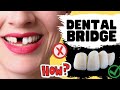 Dental Bridge Procedure for Missing Teeth { IN DEPTH Review of Risks & Benefits}
