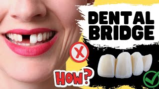 Dental Bridge Procedure for Missing Teeth { IN DEPTH Review of Risks & Benefits}