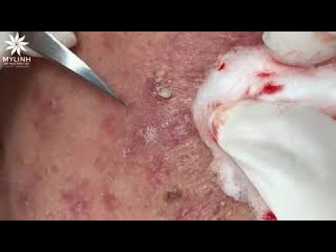 Acne Treatment #148
