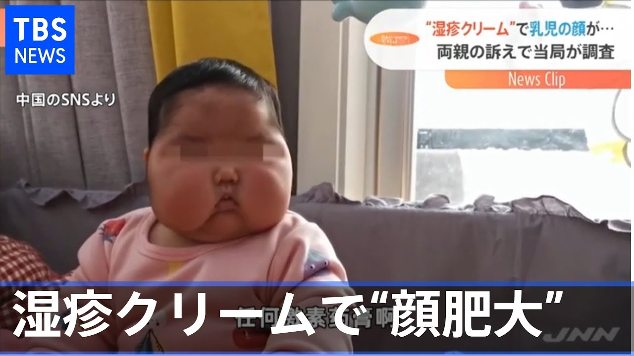 抗菌クリームで乳児の顔肥大疑惑 中国で批判殺到 Nスタ Youtube