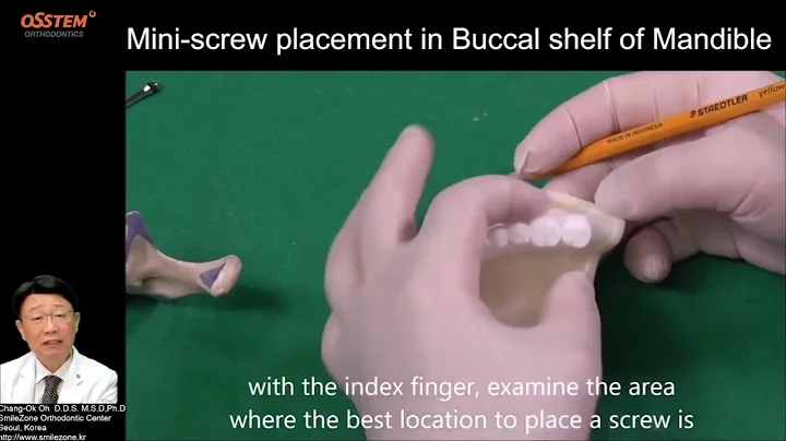 8. Buccal Shelf (When and How to use "Orthodontic Screw")