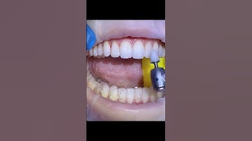 trám răng thẩm mỹ #compositeveneers #composite #dental #dentist #shortvideo #short #shorts