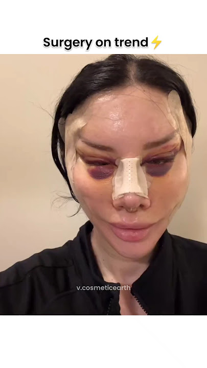 full face surgery😱🔥#shorts #cosmeticsurgery #beauty