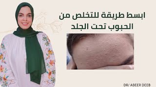 علاج الحبوب تحت الجلد ( الرؤوس البيضاء في الوجه)