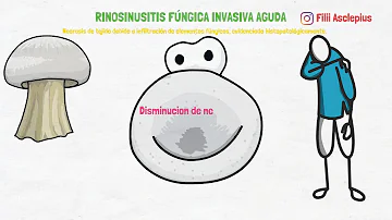 ¿Cuáles son los síntomas de la sinusitis fúngica invasiva?