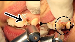 علاج وإزالة تسوس الاسنان