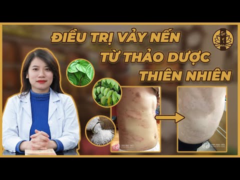 Video: 3 cách đi bơi khi bị bệnh vẩy nến