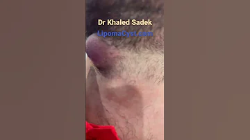 Large Abscess Dr Khaled Sadek Blackheads Skincare LIPOMACYST Clinic 