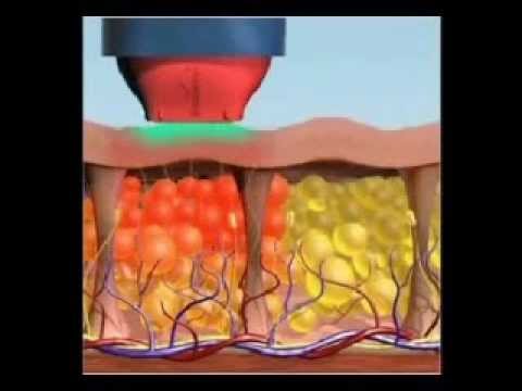 ტერმაჟი--გაახალგაზრდავება ერთ დღეში