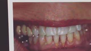 Soft Tissue Graft | McCordsville Dentist screenshot 4