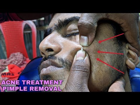 acne-treatment---pimple-remova