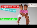 Riskiest Conjoined Twins Separations! Before and After~Body Bizarre