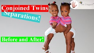 Riskiest Conjoined Twins Separations! Before and After~Body Bizarre