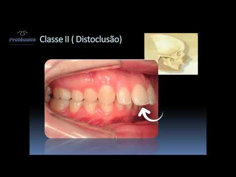 Vídeo: O que significa neutroclusão na classificação dos ângulos?