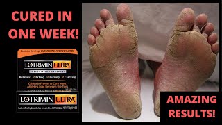 How To Cure Athlete’s Foot Fast In 1 Week!  - Toe Fungus Journey