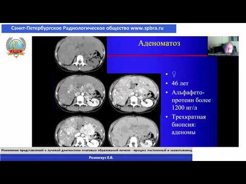 Розенгауз Е.В. Изменение представлений о лучевой диагностике очаговых образований печени