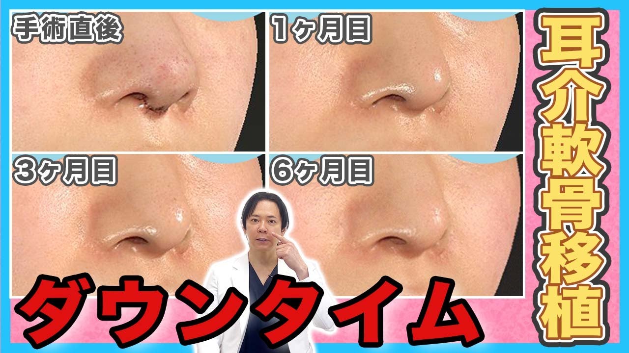 【鼻整形】耳介軟骨移植のダウンタイム｜腫れや傷跡はいつまで目立つ？