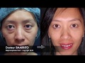 Laser blepharoplasty dr smarrito  chirurgie des paupires au laser