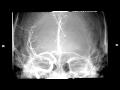 Balloon-assisted coil embolization of small intracranial aneurysms