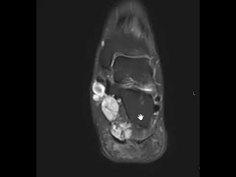 Plantar Fibromatosis