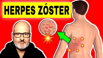 ¿Qué ocurre cuando el herpes zóster no se trata?