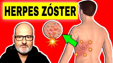 ¿Se puede tratar el herpes zóster después de 72 horas?