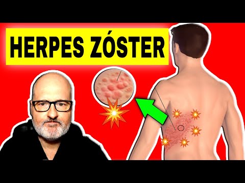 Video: Cómo tratar el herpes zóster: 15 pasos (con imágenes)