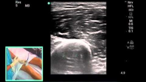 How to: Ultrasound Guided Saphenous Nerve Block Scanning Technique