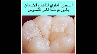المادة السادة لحماية الاسنان من التسوس Fissure sealants for protection of teeth from dental caries