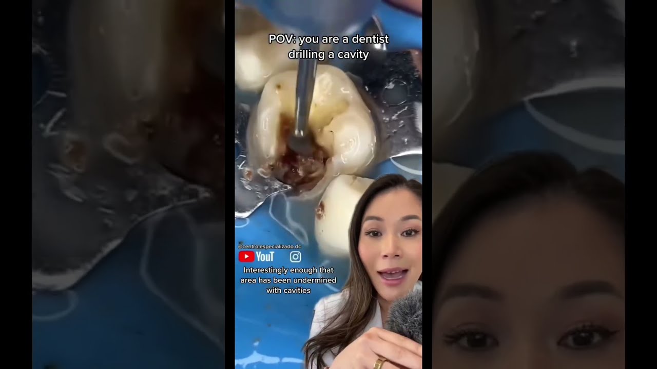 Dentist Drills A Massive Cavity Drillandfill Filling Rootcanal Crown
