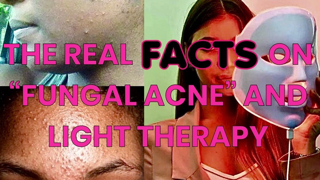The Real Facts on Fungal Acne and Light Therapy Masks with ARTICLES