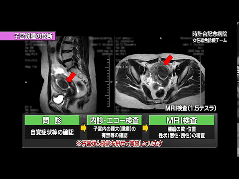 子宮筋腫の動画 画像 動画検索 マイルドサイト