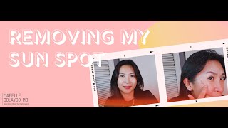 Removing my Sun Spot