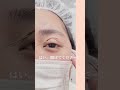 【二重整形】理想の二重幅見つけた☺️✨