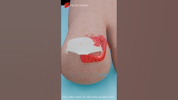 Truth About Ingrown Nails: Explained in 3D Animation #shorts #animation